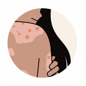 Eczema@3x